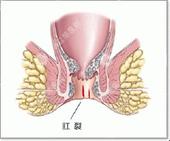 肛裂是啥原因所引起的呢